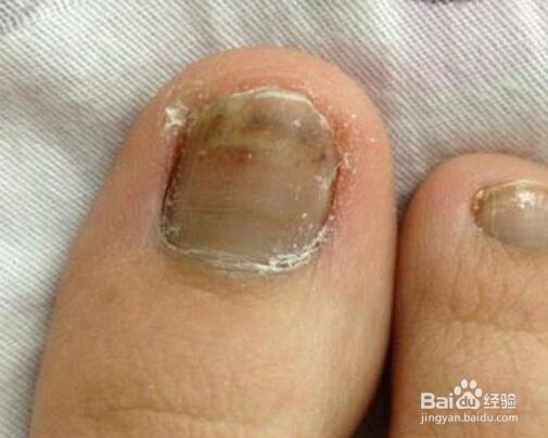 教你怎么治灰指甲