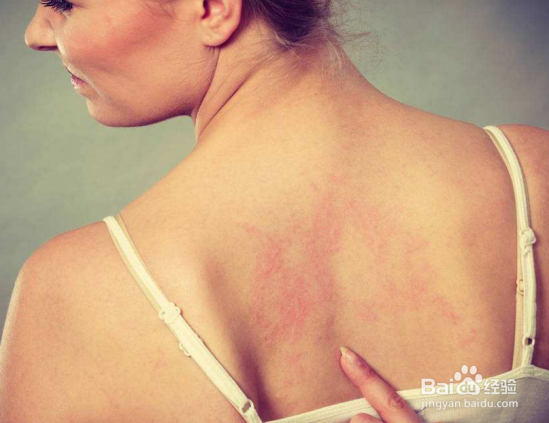 治疗湿疹用什么药膏好?怎么治疗湿疹比较好?