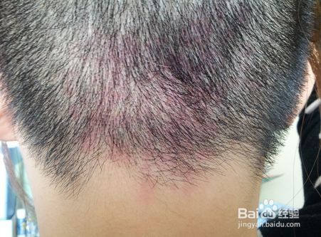 头皮上长痘痘怎么办