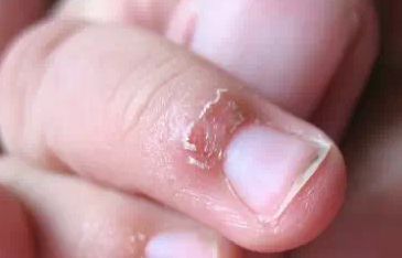 指甲周围长倒刺，一招就能轻松解决