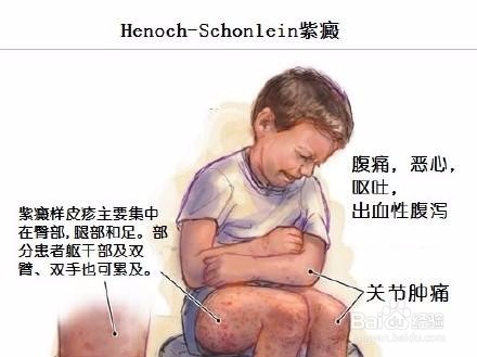 过敏性紫癜患者治疗期间应注意什么？