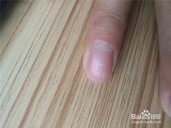 指甲上长白色的斑是怎么一回事?