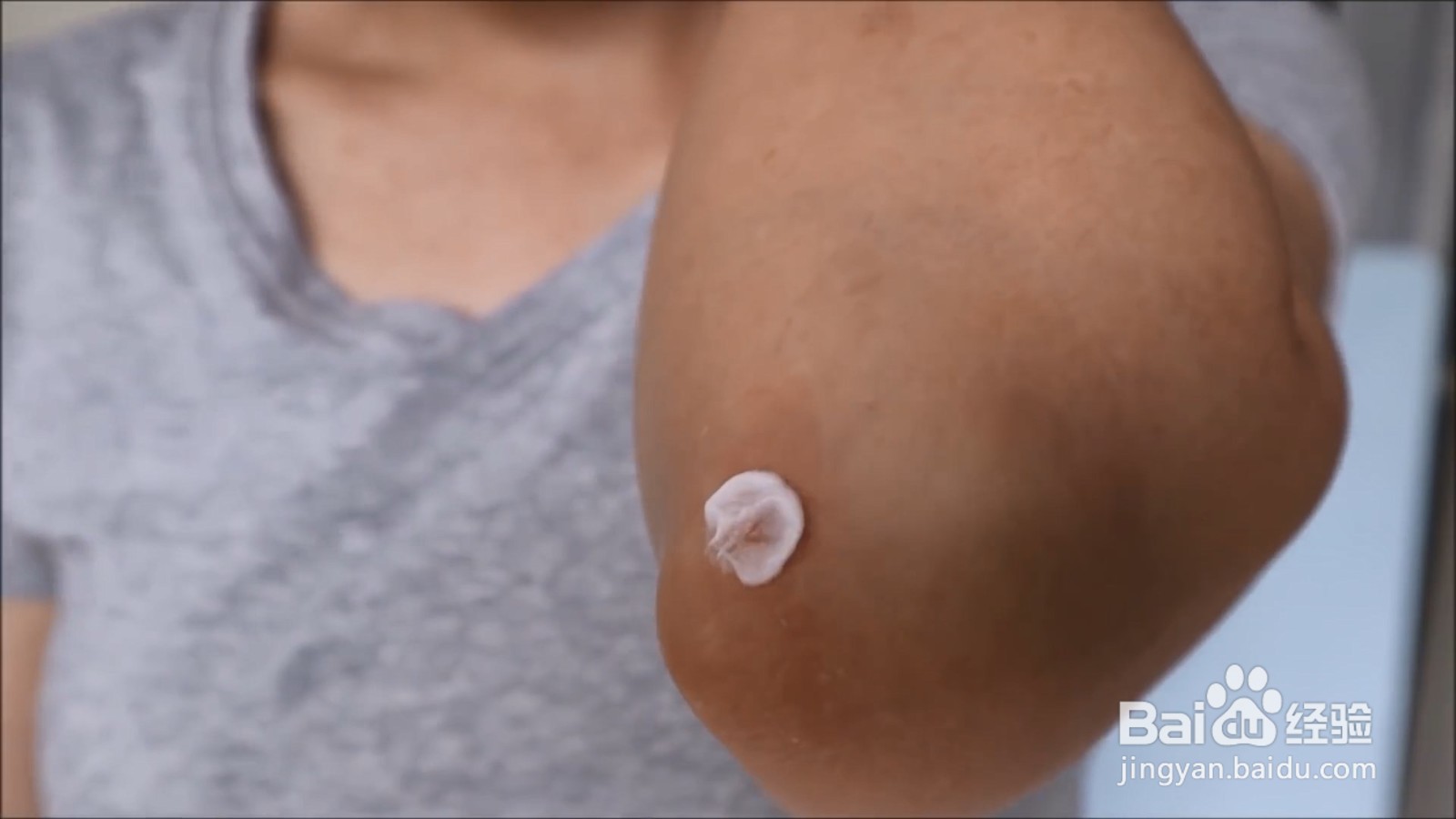 被蚊子咬了怎样快速止痒?