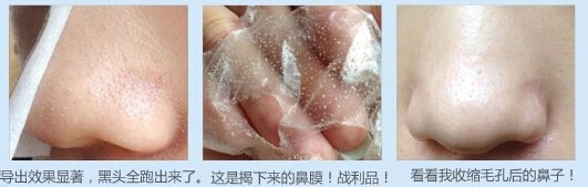 去除黑头最有效的方法