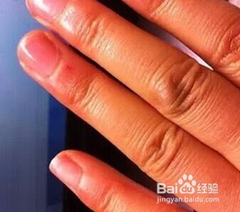 老年人“青筋”凸起什么缘故呢