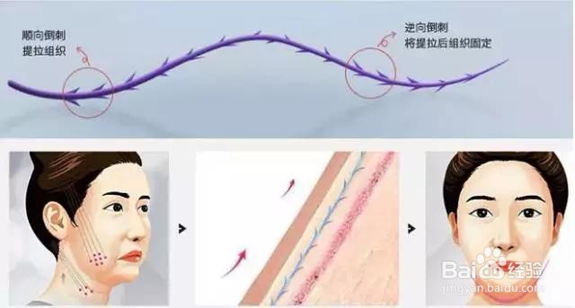 30岁的小李面部线雕多久消肿，做了什么事？