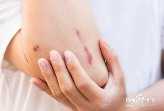 伤口不愈合的原因