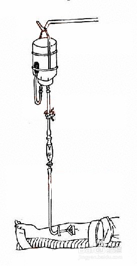 基础护理之静脉输液法