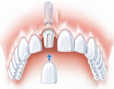 即刻种植牙需要注意什么