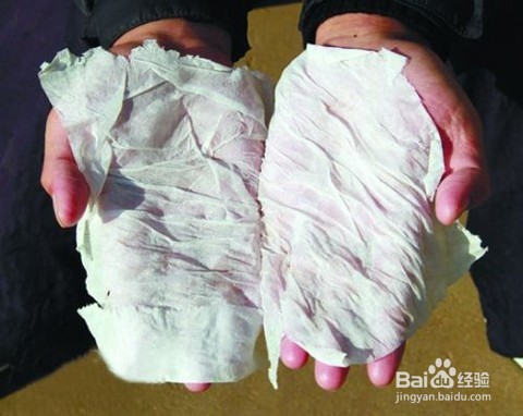 手汗症的症状 缓解手汗症的方法