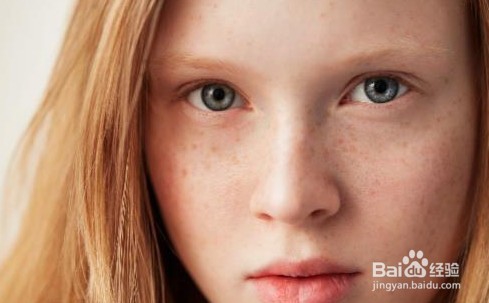 雀斑如何防治与清除
