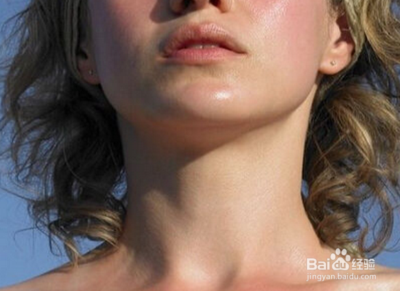 皮肤晒红后怎么办