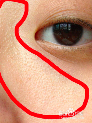 闭口粉刺如何化妆