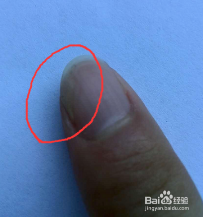 指甲和肉分离怎么愈合