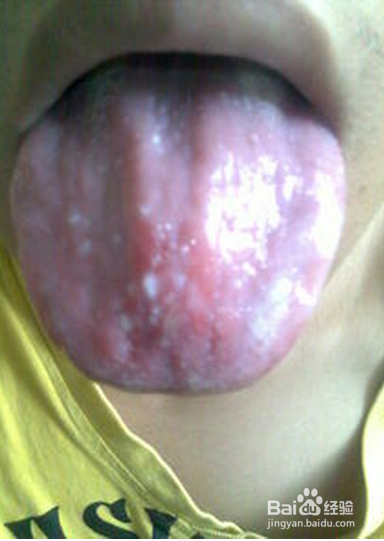 舌头上长疱疹怎么治