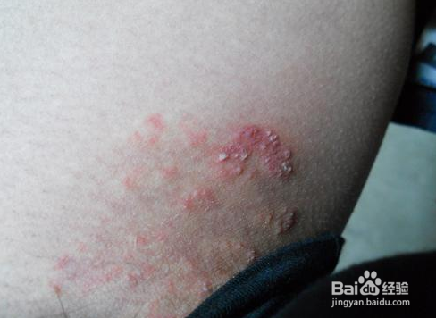 股癣最佳治疗方法