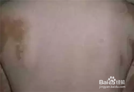 夏季治疗白殿疯有哪些好处