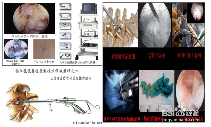 椎间盘突出阶梯式治疗方法介绍