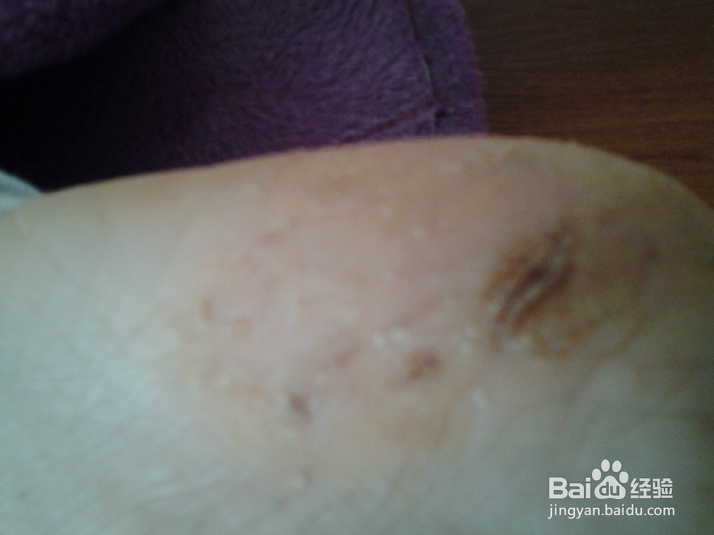 香蕉皮巧治皲裂