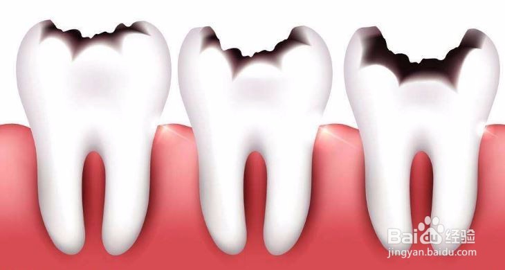 蛀牙根管治疗怎么回事？根管治疗流程
