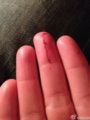 手部受伤后的急救方法