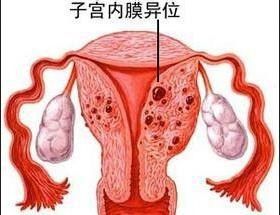 子宫内膜异位症 巧克力囊肿恐患卵巢癌 常见症状
