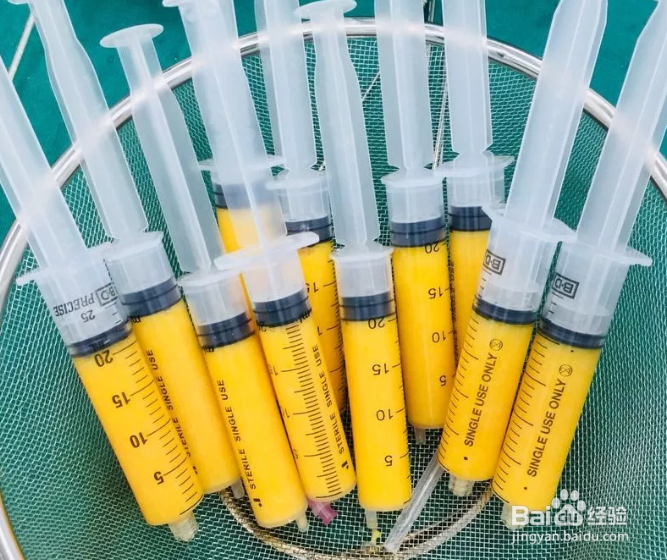 什么是填脂肪、自体脂肪填充大约需要多少钱？