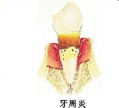 自己就可以判断有没有牙周病