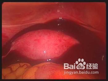 什么样的女性最容易宫外孕