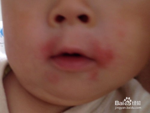 婴儿口水疹怎么办