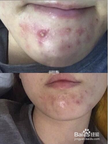 决不能忽视的螨虫，灭闭口、祛痘痘的好方法!