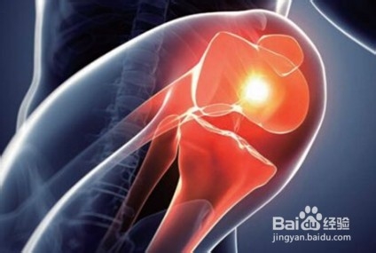 中老年人骨关节炎症状的四种护理