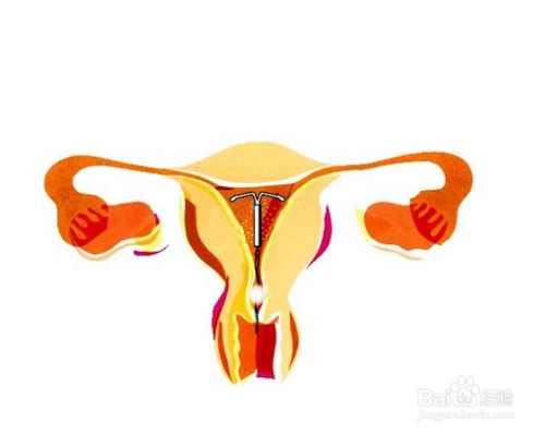 体检b超发现避孕环移位怎么办?