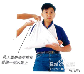 手臂骨折的紧急手褂技巧