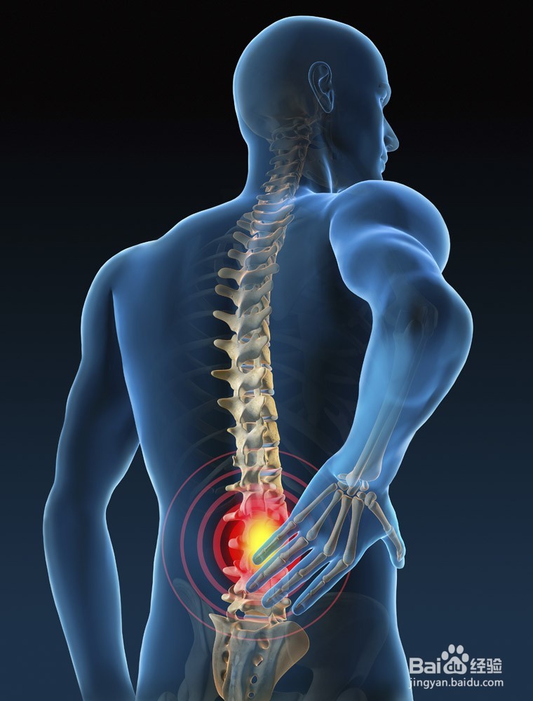 腰间盘突出最简单的治疗方法