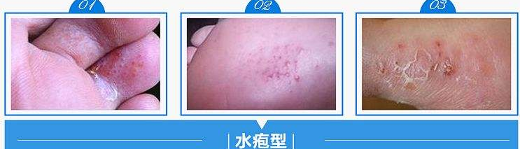 脚上长水泡很痒用什么药