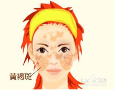 脸上长斑的祛斑方法