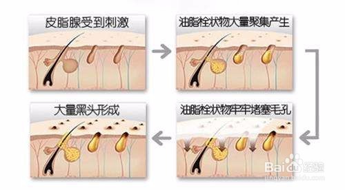 如何清除黑头、缩小毛孔和清洁皮肤呢