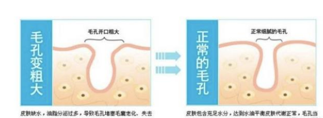 哪些坏习惯会导致毛孔越撑越大？