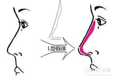 鼻梁塌了怎么办