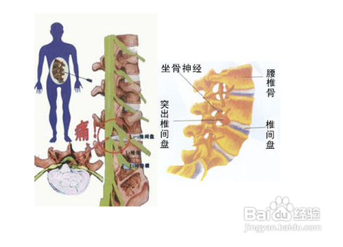腰椎间盘膨出的症状