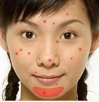 脸部痘痘辨别自己的身体信号！