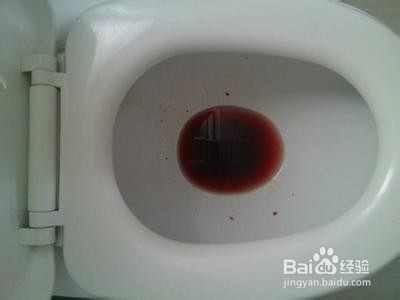 得了痔疮怎么办
