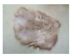 整形术后会不会有疤痕？