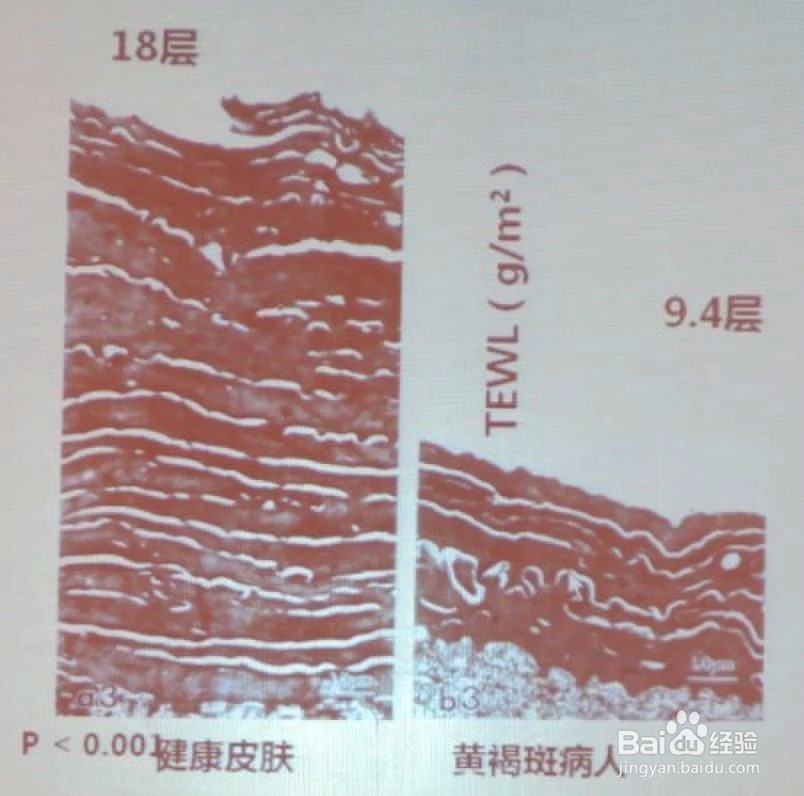 脸上长黄褐斑的原因,你知道的可能都是错的