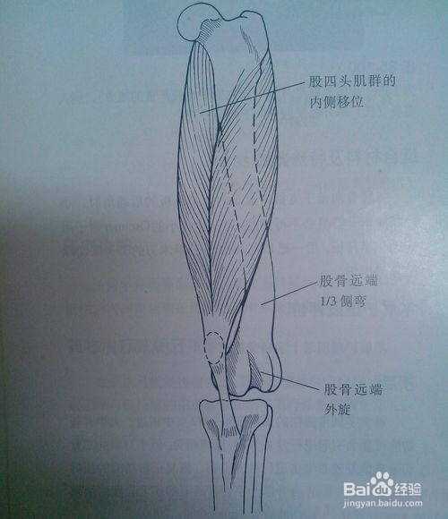 中医如何治疗髌骨软化症