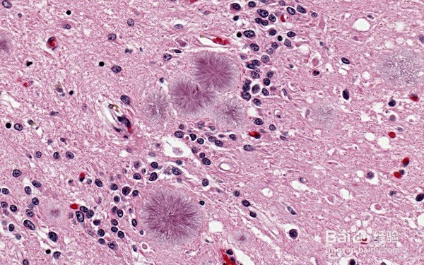 扁平苔藓症状哪些较常见