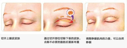 最好的除皱纹方法：[3]上眼睑除皱效果如何