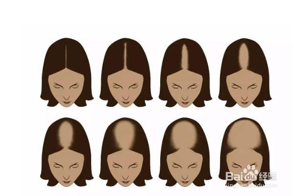 总是掉头发有哪些拯救的方法