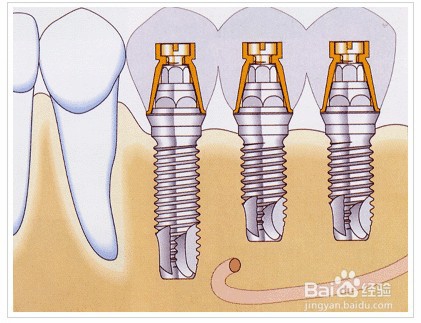 合肥种牙多少钱